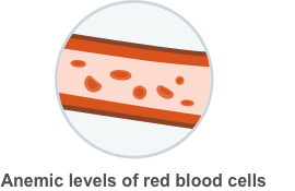 Illustration indicating fewer red blood cells
