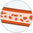 Illustration indicating fewer red blood cells